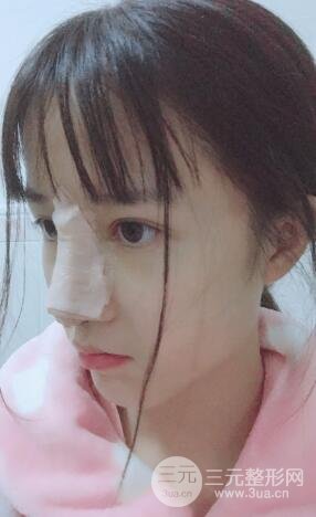 柏麗李勁良假體隆鼻案例果分享！小巧精致又立體~