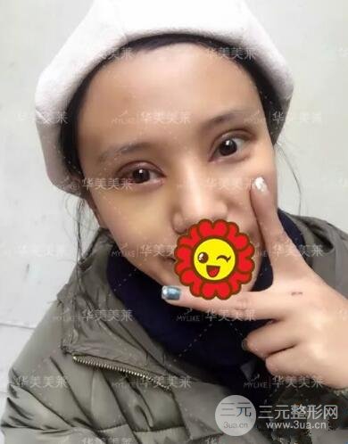 昆明華美楊繼紅全切雙眼皮怎么樣？真實案例圖片分享~