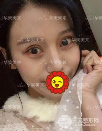 昆明華美楊繼紅全切雙眼皮怎么樣？真實案例圖片分享~