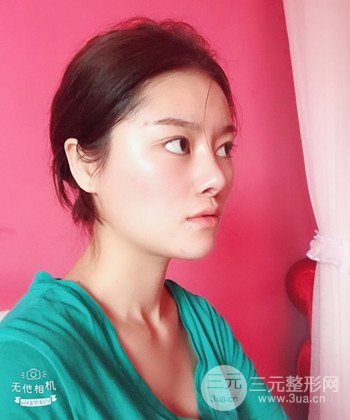 達(dá)拉斯綜合隆鼻后對比照片，顏值提高不是夢