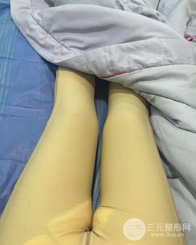上海九院張余光大腿吸脂+臀部吸脂，恢復過程案例分享~