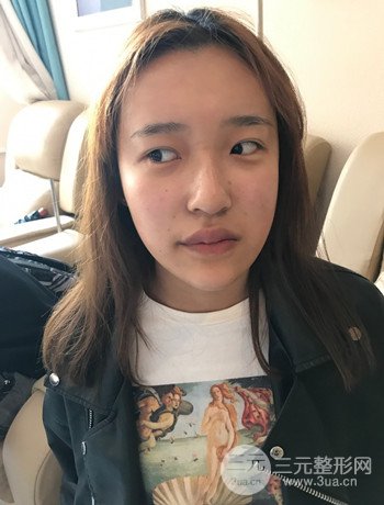 上海面部脂肪填充一個(gè)月果超明X、妥妥減齡十歲！