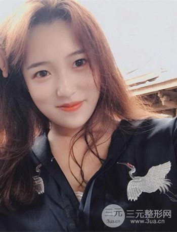 上海面部脂肪填充一個(gè)月果超明X、妥妥減齡十歲！