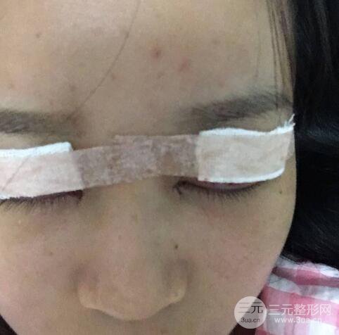 芭比電雙眼皮多項整形術后分享，雙眼皮拯救死魚眼！