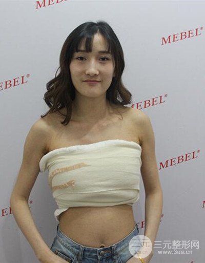 蘇州美貝爾假體隆胸案例，對比圖恢復過程分享~