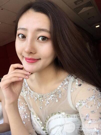 【肋軟骨隆鼻+歪鼻矯正案例】降低風(fēng)險(xiǎn)無排異，可隨意揉捏