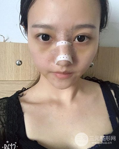 武漢美侖陳遠(yuǎn)海假體隆鼻案例，恢復(fù)過程分享~