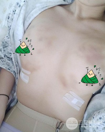 武漢同濟(jì)自體脂肪隆胸案例，恢復(fù)過程前后對(duì)比圖分享~