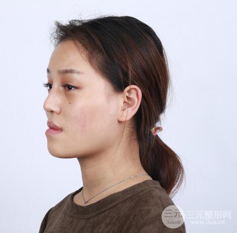 【下頜角+顴骨+下巴】全臉磨骨整形，術(shù)后的我人生開掛了！