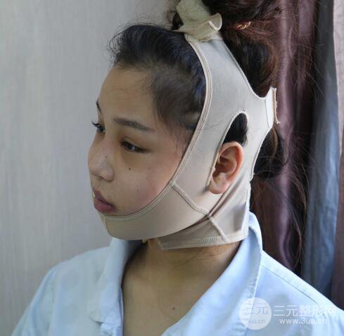 【下頜角+顴骨+下巴】全臉磨骨整形，術(shù)后的我人生開掛了！