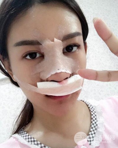 南京華美沈正宇假體隆鼻恢復過程前后對比圖分享~