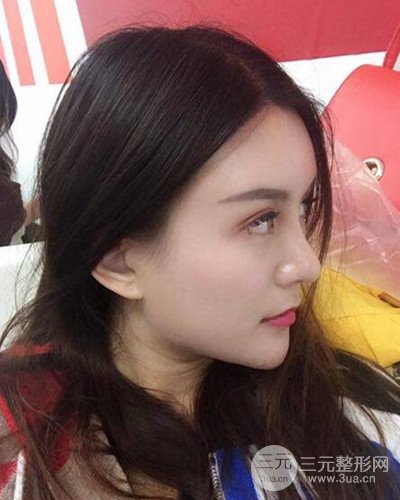 南京華美沈正宇假體隆鼻恢復過程前后對比圖分享~