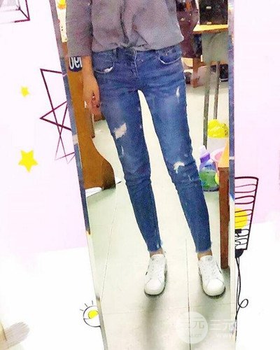 廣州韓妃大腿吸脂案例，恢復(fù)過程前后對比圖片分享~