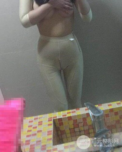 廣州韓妃大腿吸脂案例，恢復(fù)過程前后對比圖片分享~