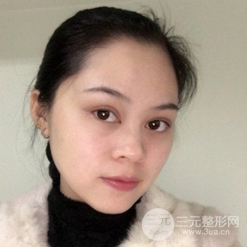 廣州激光祛雀斑果不反彈、恢復(fù)過程圖片分享