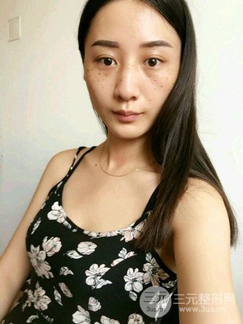 朱彤玥激光祛斑案例、兩個(gè)月果對(duì)比超明X
