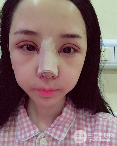 深圳蒳美邇朱燦醫(yī)生眼隆鼻整形案例分享，附上前后對比照~