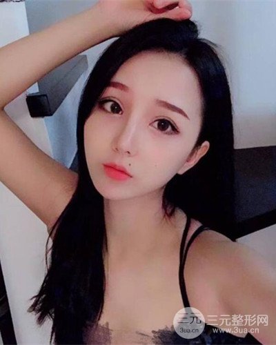 深圳蒳美邇朱燦醫(yī)生眼隆鼻整形案例分享，附上前后對比照~