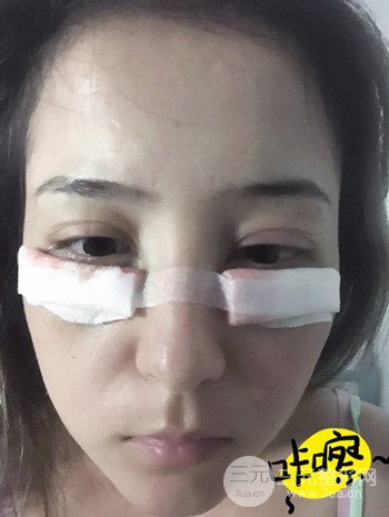 廣州內(nèi)切去眼袋術(shù)后恢復(fù)過(guò)程案例對(duì)比分享