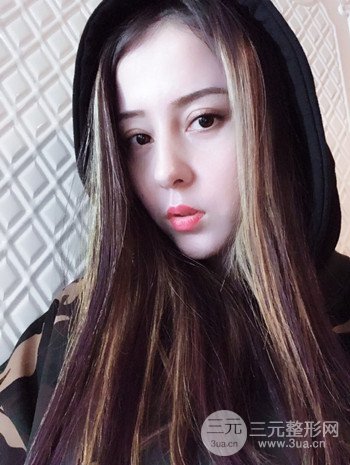 廣州內(nèi)切去眼袋術(shù)后恢復(fù)過(guò)程案例對(duì)比分享