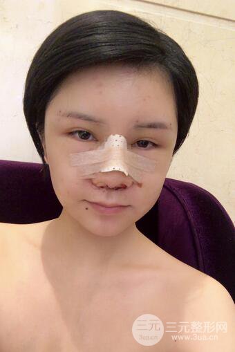 做了隆鼻整形隆鼻之后，短發(fā)女孩也可以性感！