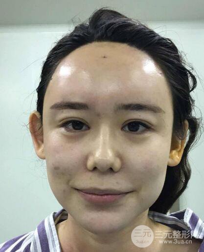 全臉自體脂肪填充，填充不飽滿還可以瘦臉_真人案例