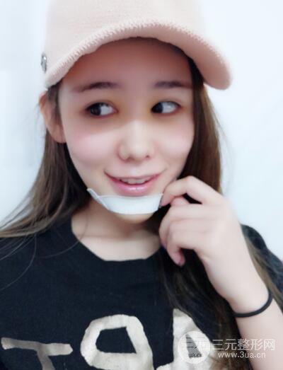 全臉自體脂肪填充，填充不飽滿還可以瘦臉_真人案例