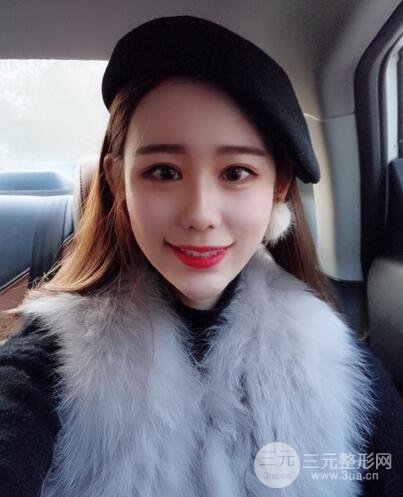 全臉自體脂肪填充，填充不飽滿還可以瘦臉_真人案例