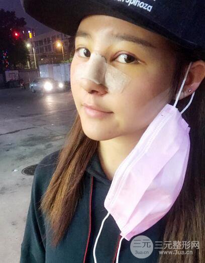 膨體隆鼻術(shù)后恢復(fù)果圖_全過程解密