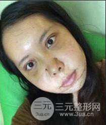 顴骨磨骨改臉型過程和恢復步驟照片（圖）