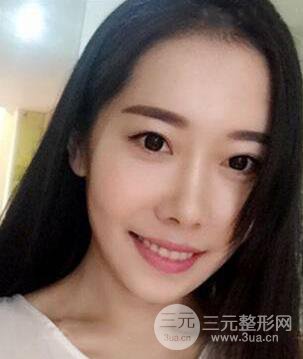 顴骨磨骨改臉型過程和恢復步驟照片（圖）