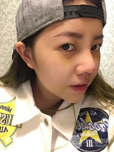 西安西京醫(yī)院整形科潘勇隆鼻整形案例以及前后對(duì)比圖展示~