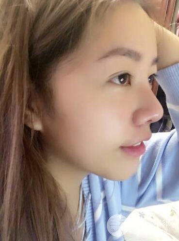 西安西京醫(yī)院整形科潘勇隆鼻整形案例以及前后對(duì)比圖展示~