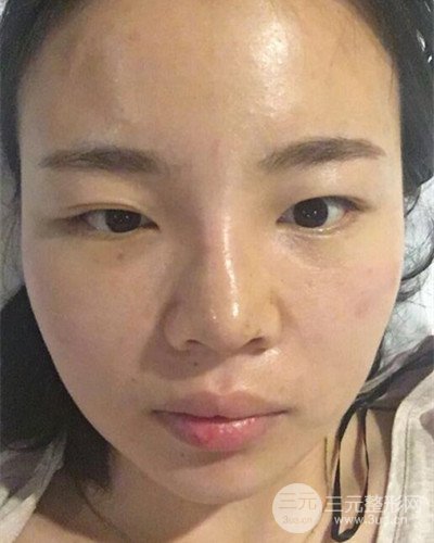 蘇州美萊尹飛隆鼻整形案例，前后恢復(fù)圖分享~