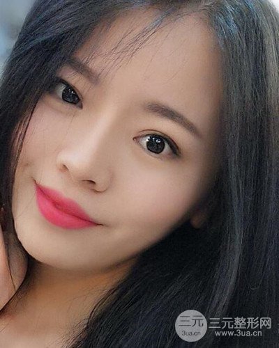 蘇州美萊尹飛隆鼻整形案例，前后恢復(fù)圖分享~