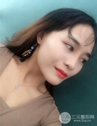 李青峰做隆鼻的風(fēng)格|案例果圖日記