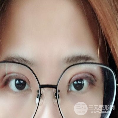 無錫菲尚徐火旺雙眼皮案例前后對(duì)比圖