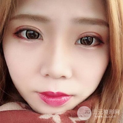 無錫菲尚徐火旺雙眼皮案例前后對(duì)比圖