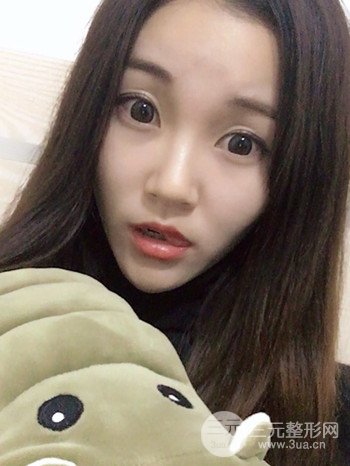 濟(jì)南硅膠假體墊下巴真人案例、下巴改變整個(gè)臉型