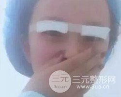南京鼓樓譚謙醫(yī)生切開雙眼皮案例，恢復(fù)圖分享~