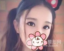 南京鼓樓譚謙醫(yī)生切開雙眼皮案例，恢復(fù)圖分享~