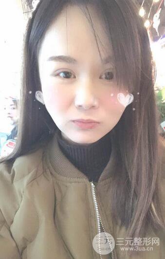 磨骨瘦臉（下頜角切除）恢復(fù)過程及前后對(duì)比照片