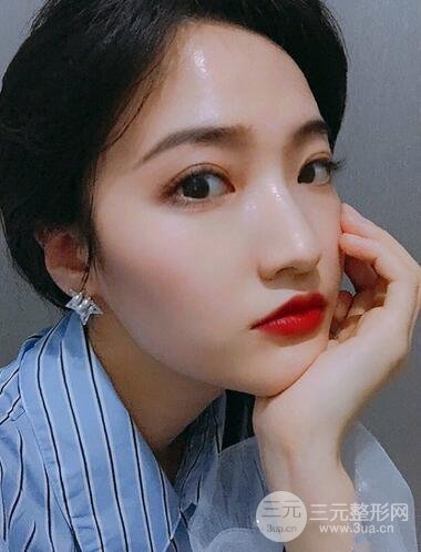 重慶華美何春濤雙眼皮案例圖片恢復(fù)記錄