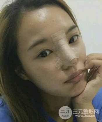 模特做隆鼻整形真實(shí)日記分享，附上恢復(fù)過程圖