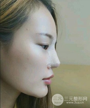 模特做隆鼻整形真實(shí)日記分享，附上恢復(fù)過程圖