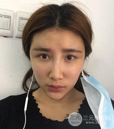 網(wǎng)絡(luò)主播做自體脂肪豐太陽穴真實(shí)案例分享，果杠杠的