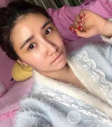 網(wǎng)絡(luò)主播做自體脂肪豐太陽穴真實(shí)案例分享，果杠杠的