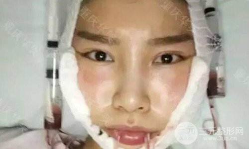 重慶華美潘寶華磨骨怎么樣?整形案例恢復圖片分享