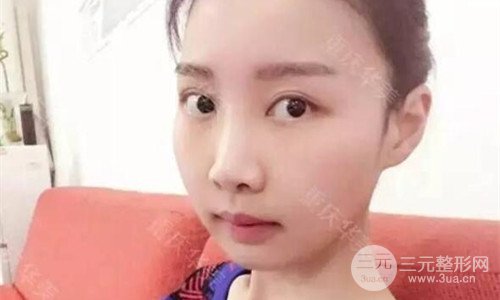 重慶華美潘寶華磨骨怎么樣?整形案例恢復圖片分享