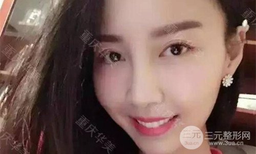 重慶華美潘寶華磨骨怎么樣?整形案例恢復圖片分享